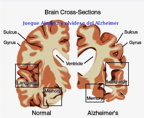 Ajedrez vs Alzheimer